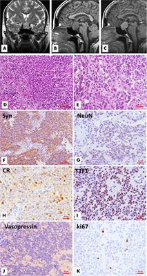 A Clinicopathological and Molecular Analysis of Sellar/Suprasellar Neurocytoma Mimicking Pituitary Adenoma